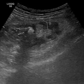 Plain radiograph of the abdomen showing “thumbprinting” (arrow) representing significant bowel mucosal edema.