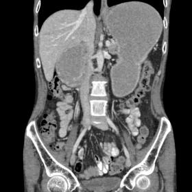 Coronal CECT in the venous phase shows a grossly distended stomach and duodenum with abrupt narrowing at the junction of its 