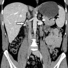 DECT coronal view at 74 keV (equivalent to a 120 kV conventional CT). Arrow indicates thrombus in the right testicular vein, 