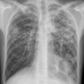 PA chest radiography shows multiple bilateral fibronodular opacities and ill-defined pulmonary nodules with an upper lung lob