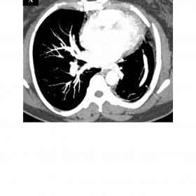 CT pulmonary angiography in (A, B) axial and (C) sagittal MIP images showing a left side anomalous unilateral single pulmonar
