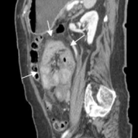 Sagittal (a) and coronal (b) contrast-enhanced CT images show the thickened membrane of EPS, with encasement of small bowel l