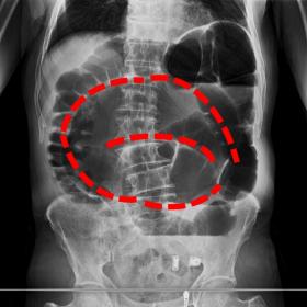Absence of rectal gas with coffee bean shaped dilatation of the sigmoid colon and three radio-opaque lines which converge tow