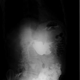 Single contrast barium study: showed a lobulated filling defect noted involving the body of the stomach. Contrast passage is 