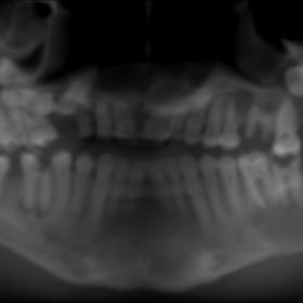 Panoramic reconstruction based on CT examination, suggesting the presence of multiple cysts in the maxilla and mandible.