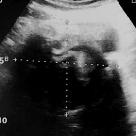 Ultrasound image showing complex hypoechoic mass with multiple linear hyperechoic foci within it.