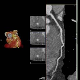 Mid segment of LAD over a luminal length of approximately 13mms is seen dipping into the myocardium of the left ventricle giv
