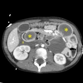 CT axial plane showing a mass of high density in the anterior convexity of duodenum (yellow *) consistent with haematoma, div