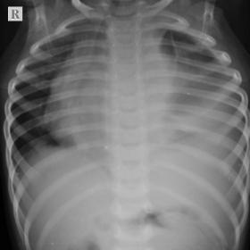 Chest radiography AP projection showing homogeneous radio opacity involving left mid and lower zone with obscuration of left 