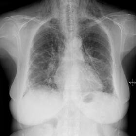 Posteroanterior plain radiograph of the thorax reveals pneumomediastinum associated with cervical subcutaneous emphysema. Per