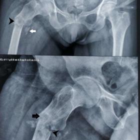 AP radiograph of pelvis shows lytic lesion (black arrow) with a horizontal fracture line (arrowhead) and fracture fragments i