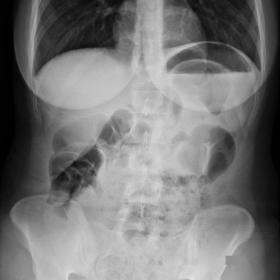 Erect abdominal radiograph shows moderate gastric distention, and some colonic intestinal loops were slightly dilated.
