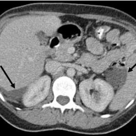 Venous phase axial contrast-enhanced CT showing low-attenuation  (approximately 0 Hounsfield units) perihepatic and perisplen