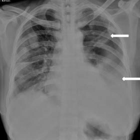 Posteroanterior chest radiograph shows multiple cavitating and non-cavitating nodules in both the lung fields. There is moder