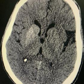 Plain CT axial image shows diffuse hyperdensity involving right striatal region (caudate nucleus and putamen)