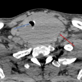 Axial section of contrast CT: Homogeneous thyroid gland tumor (red arrow) predominantly involving left lobe and isthmus parti