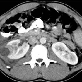 Axial CT abdomen with contrast shows complex right renal cystic lesion with surrounding perinephric fluid suggesting renal abscess