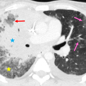 Axial contrast-enhanced chest MDCT, lung window: extensive consolidations (blue star) surrounding areas of central ground gla