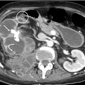 Enhanced CT in portal venous phase, axial plane (a, b), showing the enlarged right kidney with staghorn calculus (a, b straig