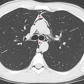 CT scan, axial image at the level of the upper mediastinum. Note the free mediastinal air (red asterisks)