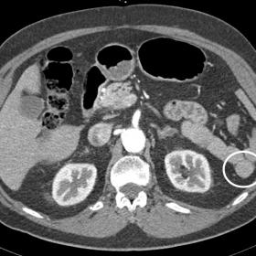 Arterial phase CT scan showing a homogeneously enhancing 2 cm nodule in the left upper abdomen. The patient has previously un