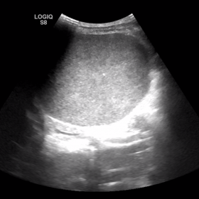 Abdominal USG. There was a lesion having well defined borders near the lower pole of the spleen, which was isoechoic relative