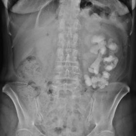 A large staghorn calculus is present in the left kidney. Left kidney enlargement is present and there are no apparent changes