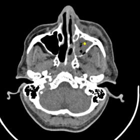 CT axial sections demonstrated a polypoidal hyperdense soft tissue density in left maxillary,ethmoid and sphenoid sinuses wit