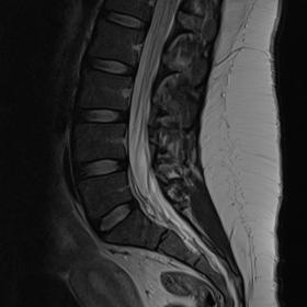 Sagittal T2WI (a) and T1 fat-supressed imaging after gadolinium administration (b) of the lumbar spine showing a diffuse enha