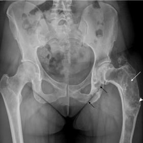 A heterogeneous, mixed lytic and sclerotic, expansile lesion involving the proximal the left femur is seen (white arrow). Sim