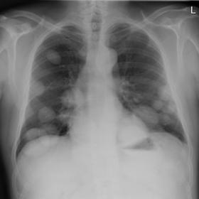 Multiple cannon ball opacities in the lungs bilaterally measuring up to 60 mm in keeping with metastatic disease.