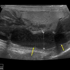 Gray scale imaging of the right epididymis shows marked hypoechogenicity and enlargement of the body and tail (arrows).