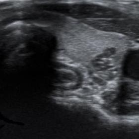 Transverse sonogram shows an elongated nodule with multiple hyperechoic foci in the left thyroid mid-portion.