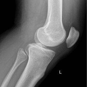 A discrete soft tissue opacity in the posterior knee is noted