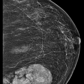 Mammogram shows circumscribed, oval mass, heterogeneously dense mass containing radiolucent (fat) and radiopaque (soft tissue