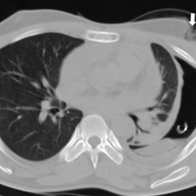 Axial Computed Tomography of chest in lung window settings showing external lacerated wound over the left anterior thorax (wh