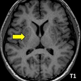 (A) Non-enhanced axial T1WI MRI at the level of the bilateral putamen showing symmetric hypointense foci at said areas (arrow