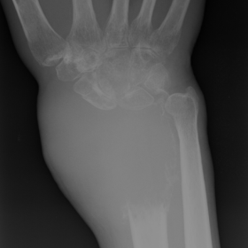 Plain radiograph of distal right forearm - 10cm lytic expansive lesion in the metaphyseal/epiphyseal region of the right radi