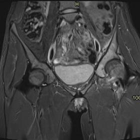 Coronal STIR MR image shows diffuse marrow oedema of the left acetabulum