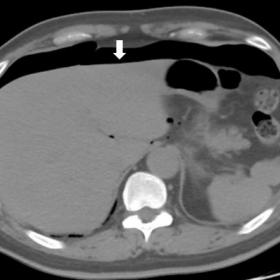 Axial Pre – contrast Computed Tomography of abdomen shows extensive extraluminal air (white arrow)