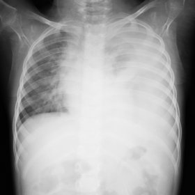 Decubitus chest X-ray shows compressed left lung with massive pleural effusion