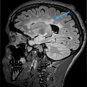 Sagittal (a) and Axial FLAIR (b) demonstrate multiple demyelinating lesions (arrows) in the white matter. Some lesions are pe