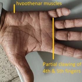 Clinical photograph of patient’s right hand shows relative wasting of hypothenar muscles and partial clawing of 4th & 5th fingers