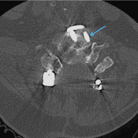 Axial unenhanced computed tomography (CT) of the cervical spine demonstrates anterior and posterior cervical fusion hardware.