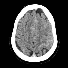 Non-contrast-enhanced CT of the brain, axial plane. Sulcal densities in the right parietal lobe (blue arrow). Also, note the 