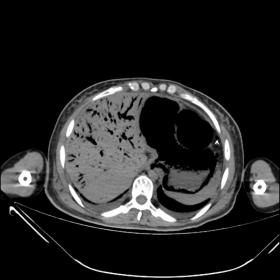 Axial non contrast CT: Intramural diffuse gas bubbles in the  esophagus wall as well as the  bilateral pleural effusion