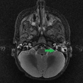 MRI axial T2 STIR. We observed a slight dilation of the left endolymphatic duct (green arrow) with a thickness of 2 mm