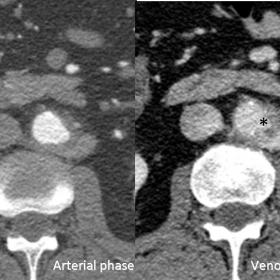 Contrast-enhanced computed tomography (CECT) in arterial (Right image) and portal venous (Left image) phase. Saccular aneurys