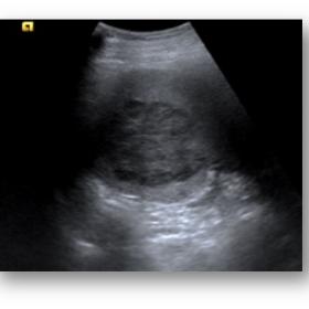 Splenic ultrasound image. A well-defined solid splenic lesion is shown.  On B-mode US, the lesion is slightly hypoechoic rega