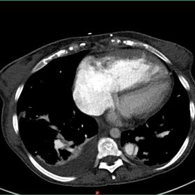 Axial CT slice, dissection flap in a segmental artery of the left lower lobe (segment X)